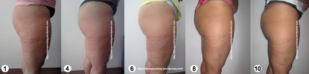 Vergleich Vorher-Nachher Bilder ARWT Cellulite Behandlung (Behandlung 1, 4, 6, 8, 10) Slimspec 
